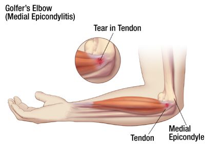 Golfer elbow