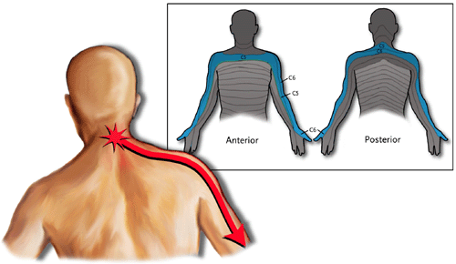 radiculopathy