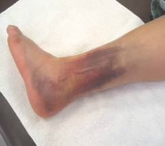 grade 3 ankle sprain